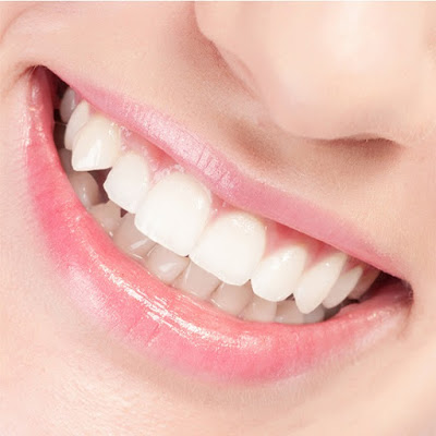 Trám răng thẩm mỹ có bền không?