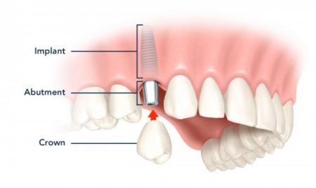 Trồng răng thẩm mỹ implant được thực hiện như thế nào?