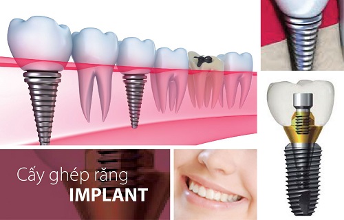 Trồng răng thẩm mỹ implant được thực hiện như thế nào? 2