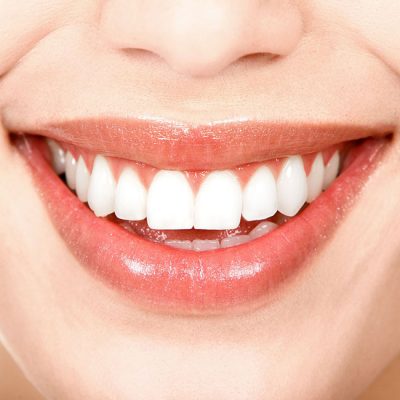 Bọc răng sứ veneer mang lại hàm răng đẹp rạng ngời
