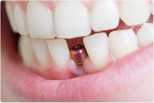 Cắm ghép răng implant nhanh chóng an toàn 1