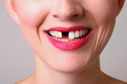 Cắm implant cho răng cửa như thế nào?