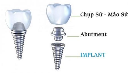 Cấy ghép răng implant giá bao nhiêu tiền?