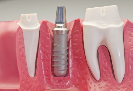 Kỹ thuật trồng răng implant 