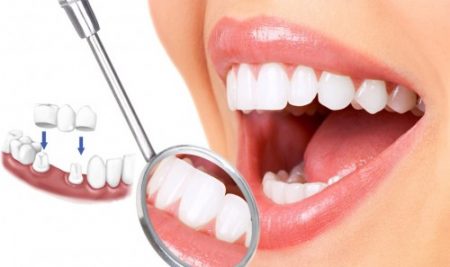 Những phương pháp trồng răng giả cố định