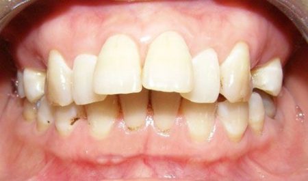 Niềng răng hô hàm trên