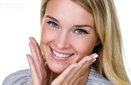 Niềng răng mắc cài sứ thẩm mỹ
