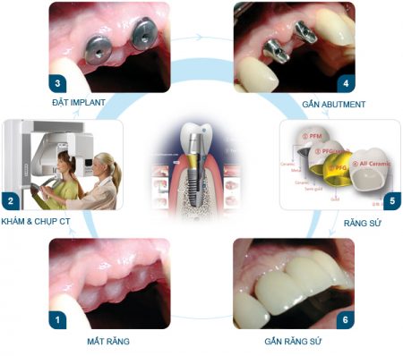 Quá trình cấy ghép implant cho răng cửa