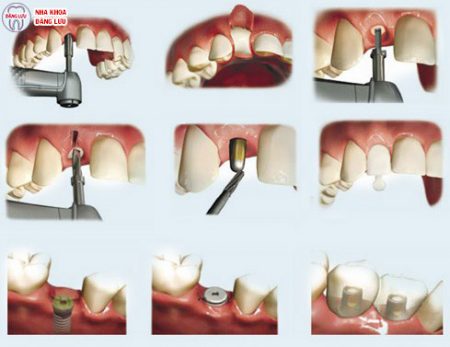 quá trình cấy ghép implant cho răng hàm như thế nào?