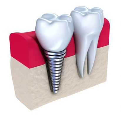 Trồng răng hàm có đau, hay nguy hiểm đến sức khỏe không?