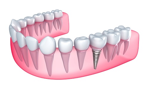 Trồng răng hàm có đau, hay nguy hiểm đến sức khỏe không? 2