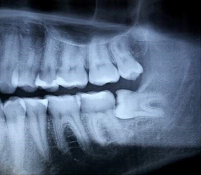 Dấu hiệu và triệu chứng mọc răng khôn