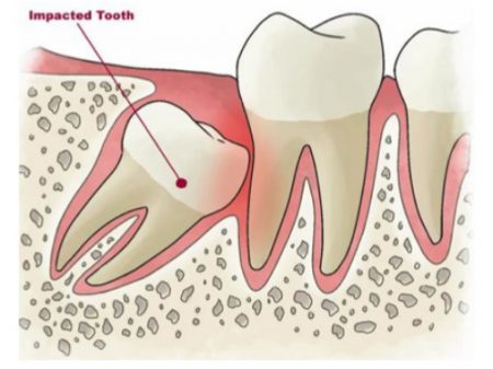 nhổ răng khôn xong phải làm gì?