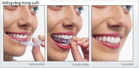 Niềng răng bằng nhựa là gì?