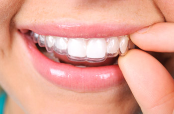 Niềng răng không mắc cài 3d clear aligner