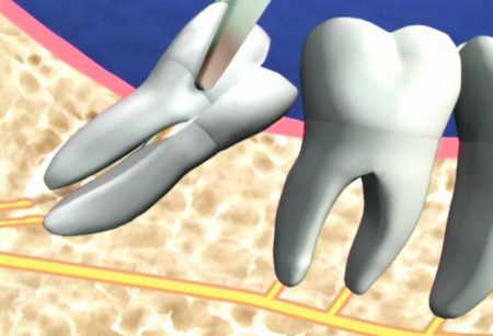 Răng khôn bị lung lay phải làm sao?
