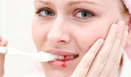 Cách chữa bệnh chảy máu chân răng