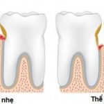 Chảy máu chân răng thiếu chất gì?