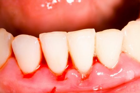 chảy máu chân răng thường xuyên phải làm thế nào?