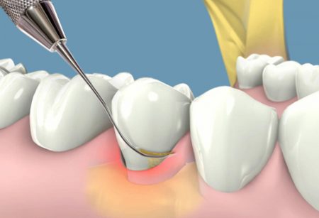 chảy máu chân răng thường xuyên phải làm thế nào?