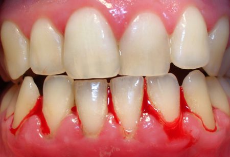 chảy máu nướu răng và cách phòng tránh