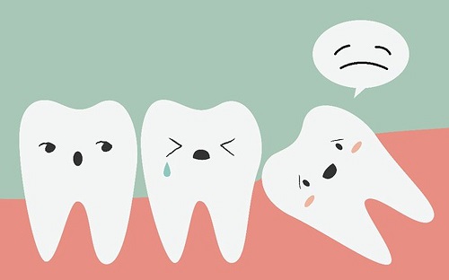 Răng khôn hàm trên mọc lệch nên làm gì? 1