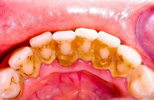 Lấy cao răng có ảnh hưởng không? Tìm hiểu về cao răng 1