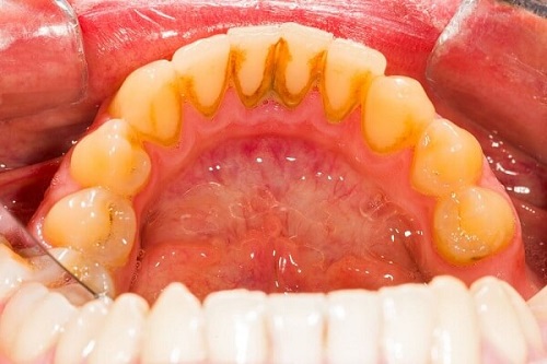 Lấy cao răng có ảnh hưởng không? Tìm hiểu về cao răng 2