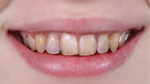 Tác hại của việc tẩy trắng răng bạn nên biết để phòng tránh 2