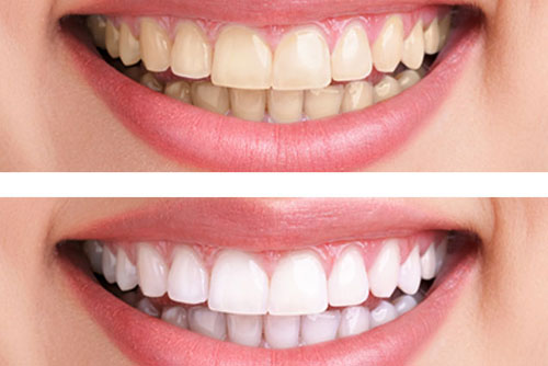 Tẩy trắng răng có ảnh hưởng gì không? Nha khoa tư vấn 1
