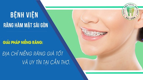 Niềng răng Cần Thơ - Tìm hiểu dịch vụ niềng răng 2