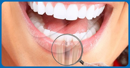 Cấy ghép răng implant ở đâu tốt nhất? Tham khảo 1