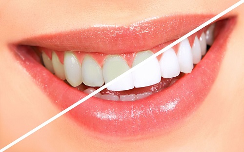 Có nên tẩy trắng răng nhiều lần? Tham khảo gợi ý từ nha khoa 1