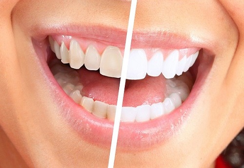 Có nên tẩy trắng răng nhiều lần? Tham khảo gợi ý từ nha khoa 2