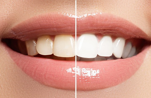 Có nên tẩy trắng răng nhiều lần? Tham khảo gợi ý từ nha khoa 3