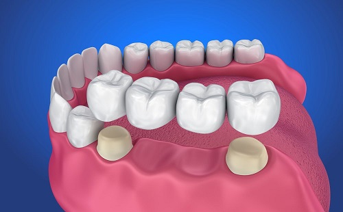 Trồng răng bằng cầu răng - Tìm hiểu về ưu và nhược điểm 2
