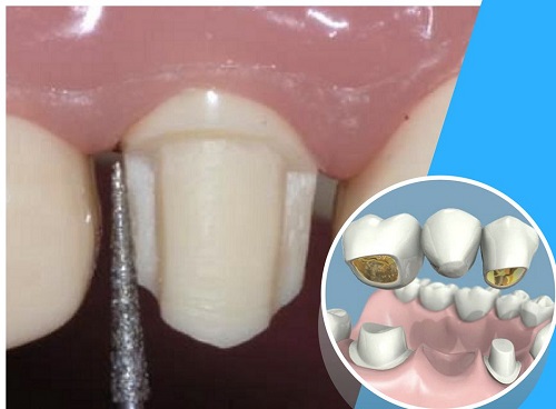 Trồng răng bằng cầu răng - Tìm hiểu về ưu và nhược điểm 3