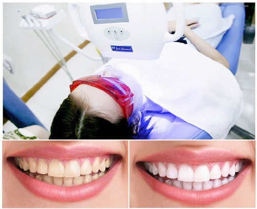 Tẩy trắng răng trong 1 tuần với cách làm nào hiệu quả? 2