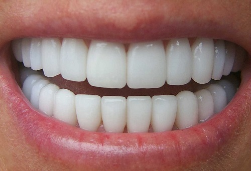 Trồng răng có nhanh không? Giải đáp từ chuyên gia 3