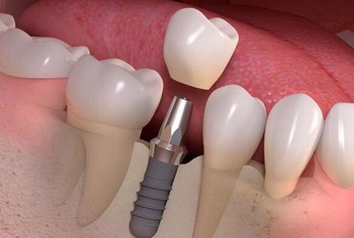 Trồng răng cối - Phương pháp phục hình nào phù hợp? 1