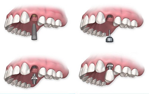 Trồng răng cối - Phương pháp phục hình nào phù hợp? 2