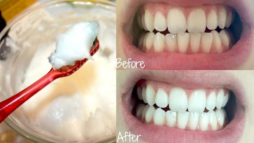 Tẩy trắng răng bằng nước gạo có hiệu quả không? 2