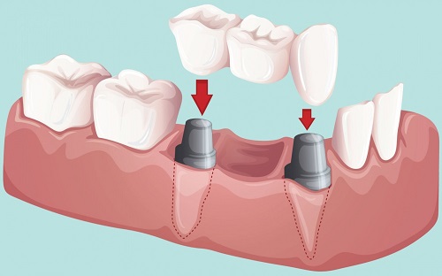 Trồng răng kiêng ăn gì giúp răng chắc khỏe hơn? 3