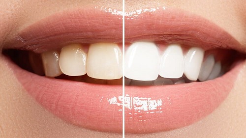 Tẩy trắng răng bằng máng có tốt không? Tìm hiểu từ nha khoa 1