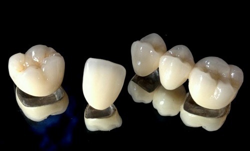 Răng sứ titan có mấy loại? Nên chọn loại nào để phục hình 1