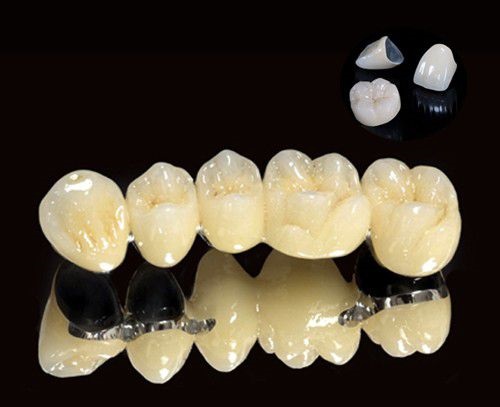Răng sứ titan có mấy loại? Nên chọn loại nào để phục hình 2