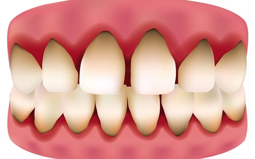 Răng sứ titan có mấy loại? Nên chọn loại nào để phục hình 3