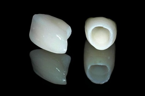 Răng sứ titan có mấy loại? Nên chọn loại nào để phục hình 4