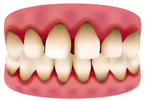 Răng sứ bị đen viền nướu - Cách khắc phục 1