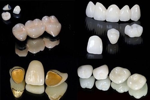 Làm răng sứ thẩm mỹ loại nào tốt nhất hiện nay? 2